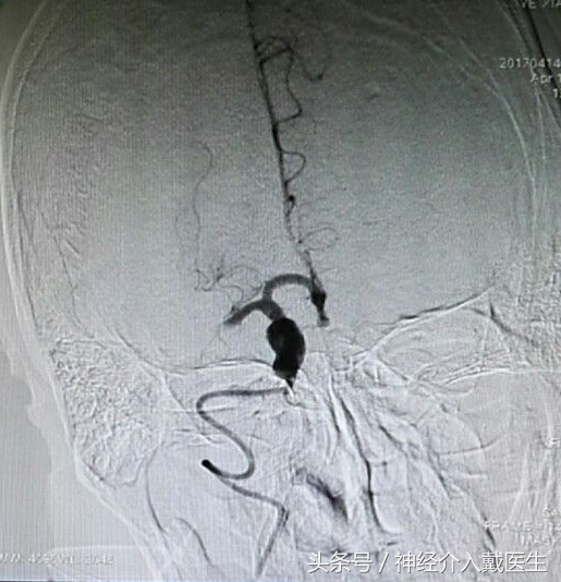 缺血性脑卒中的治疗方法有三类,缺血性脑卒中的治疗方法