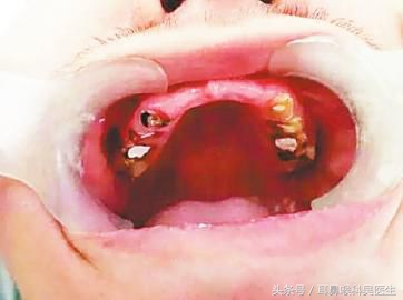 龋齿原因及防治方法,小儿龋齿的原因及防治措施