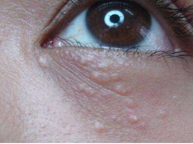 眼周脂肪粒用什么药,扒一扒胶原蛋白