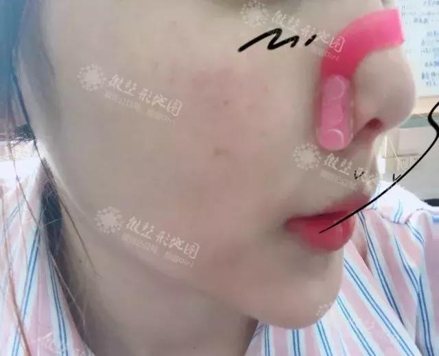 整形“神器”大测评：传说中的隆鼻夹真的靠谱吗？