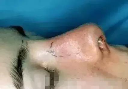 整形“神器”大测评：传说中的隆鼻夹真的靠谱吗？