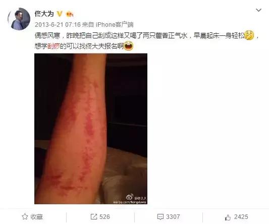 触目惊心！杨丞琳阿娇等人把刮痧过度神话，专家打脸：根本没效果