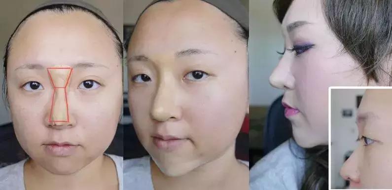 不动刀的隆鼻方法是什么,不动刀不打针的隆鼻的方法