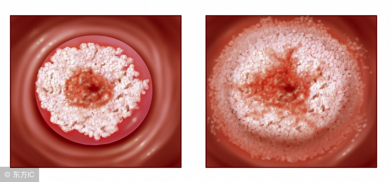 宫颈癌筛查三阶梯试题,宫颈癌筛查高级病变