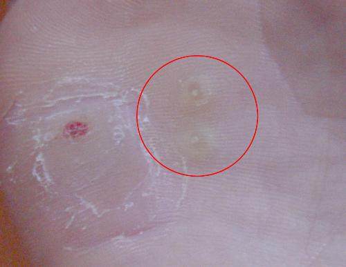 长期光脚走路会不会使脚下长老茧,脚下为什么长老茧