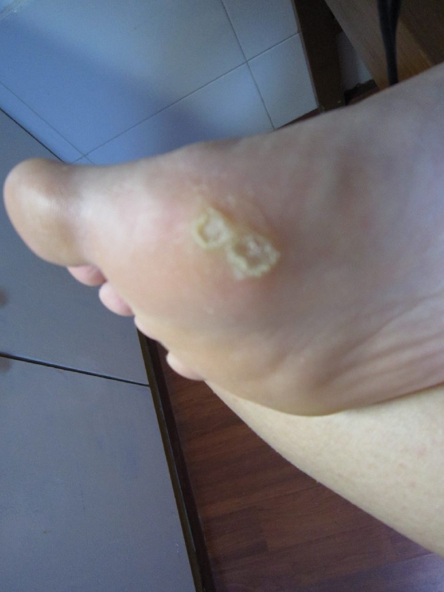 脚下出现老茧很严重该如何去除呢,脚下为什么长老茧