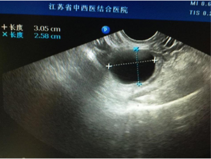 卵巢囊肿都需要做肿瘤标志物吗,卵巢囊肿都需要治疗吗