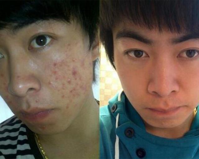 祛痘去痘印男生方法,男士怎么祛痘祛痘印效果好