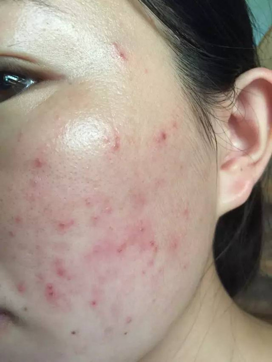 脸上长痘粉刺什么原因,脸上长粉刺是肝不好吗