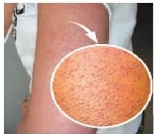 改善鸡皮肤（毛周角化症）