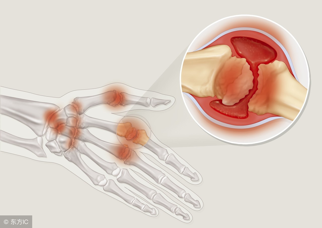 最新类风湿诊疗指南,类风湿性关节炎诊疗指南最新版