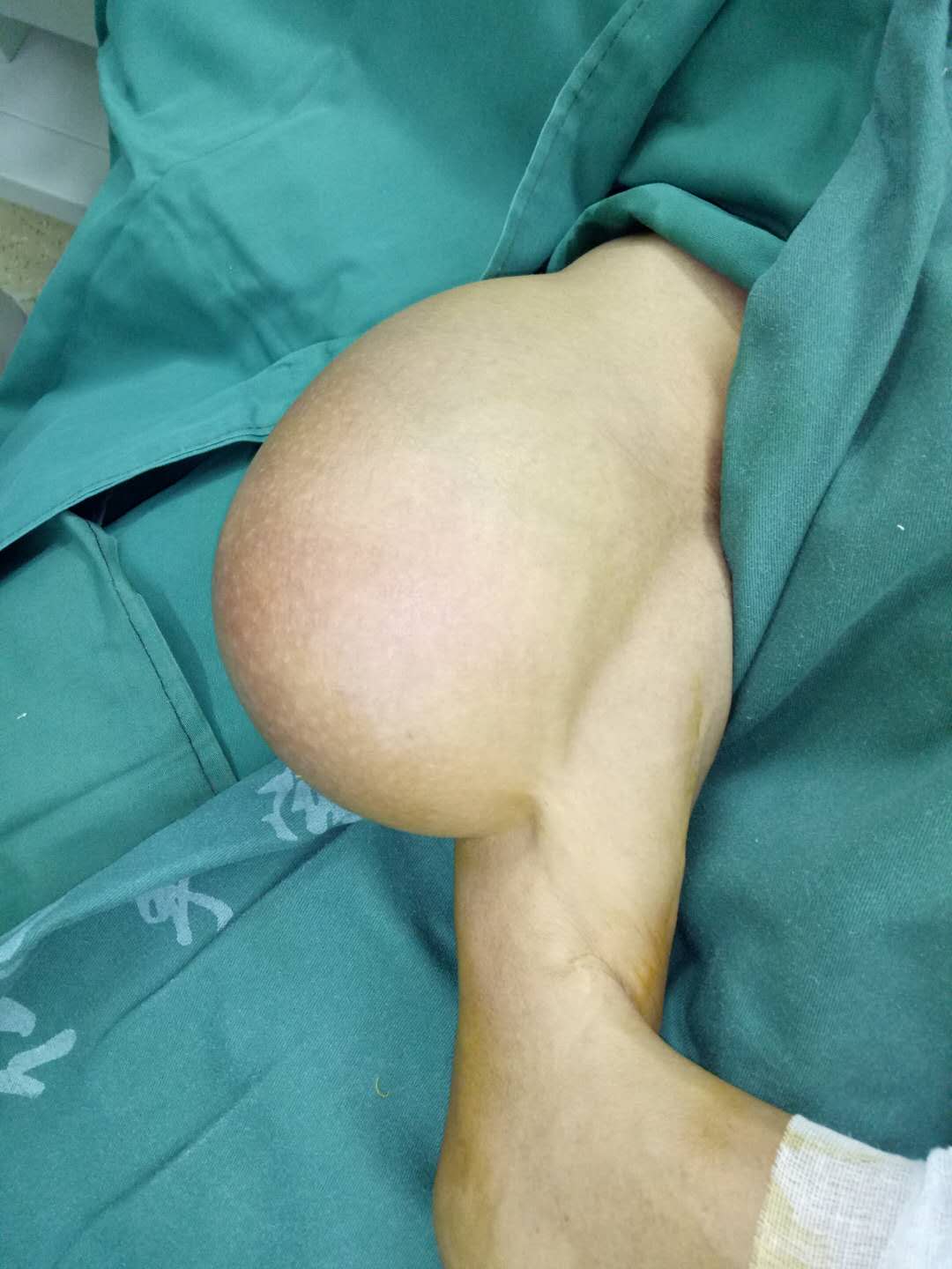 8斤重！堪比巨婴的脂肪瘤在手臂上挂了近30年！