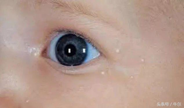 皮肤容易长脂肪粒用什么护肤品,眼周脂肪粒不能涂东西