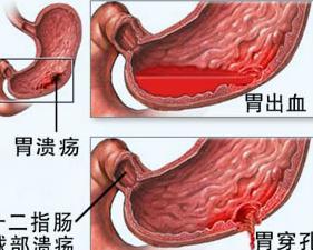 胃溃疡胃糜烂多长时间做一次胃镜,胃镜显示胃溃疡就是胃癌吗
