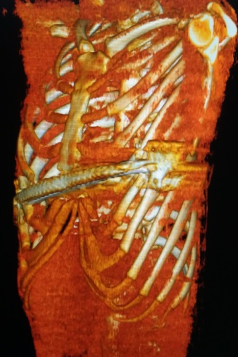 漏斗胸矫正微创手术,最新的漏斗胸微创手术