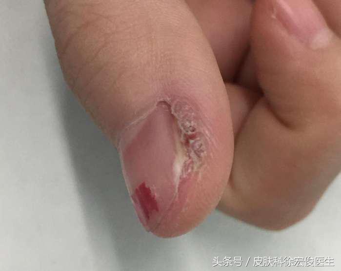 灰指甲指甲变小变厚变畸形怎么办,指甲变厚一定是灰指甲吗