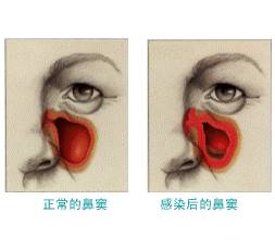 过敏性鼻炎像得了不治之症,过敏性鼻炎是不是什么大病