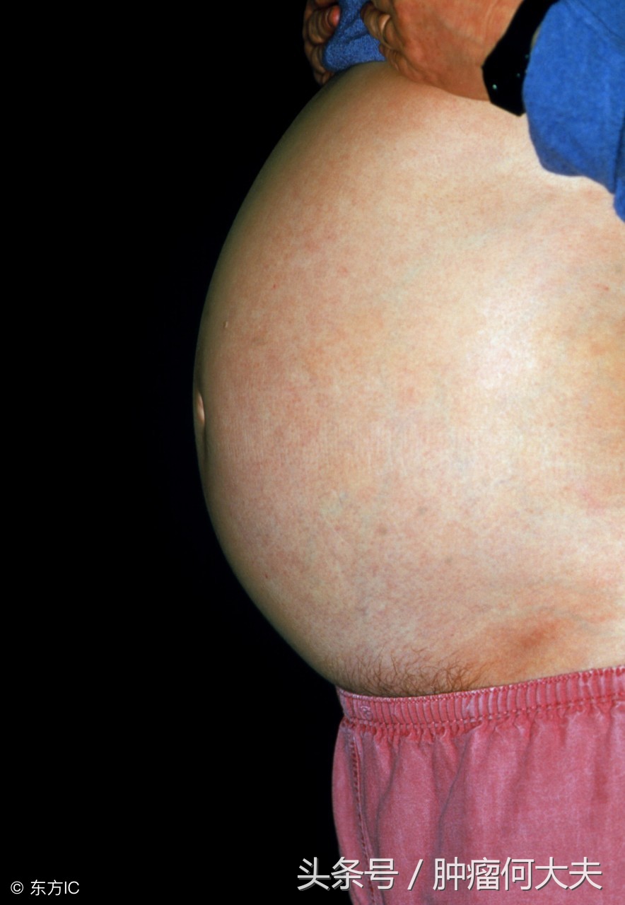 腹腔积液和癌症腹水有没有区别,腹腔引流出来的癌性腹水有毒吗