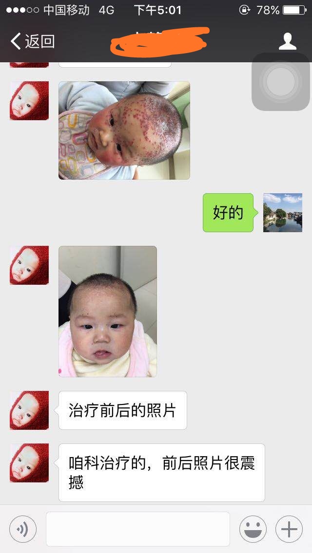儿童嘴巴长疱疹湿疹,妈妈嘴角长疱疹孩子碰到了