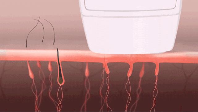 夏天脱毛不用愁看过来,脱毛好物你选对了吗