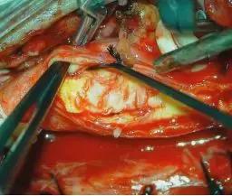 西安市第三人民医院血管外科,治疗颈动脉斑块西安哪家医院好