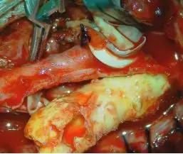 西安市第三人民医院血管外科,治疗颈动脉斑块西安哪家医院好