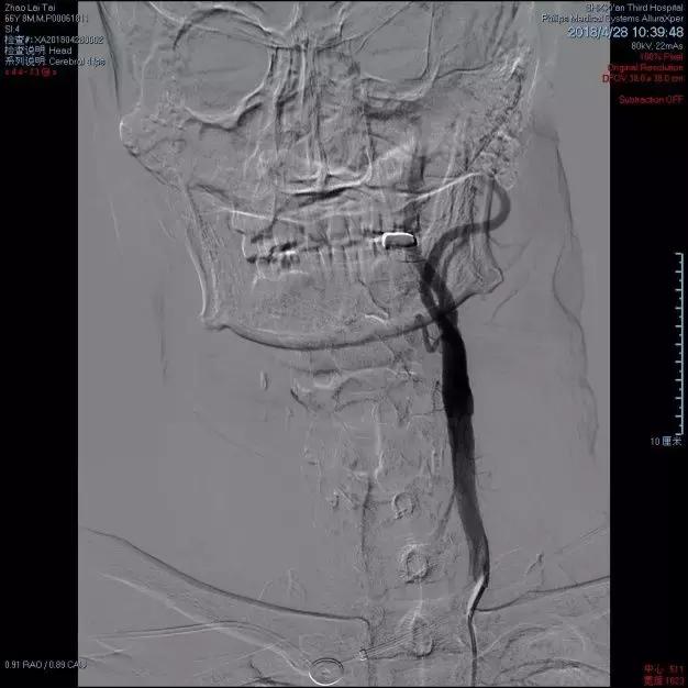 西安市第三人民医院血管外科,治疗颈动脉斑块西安哪家医院好