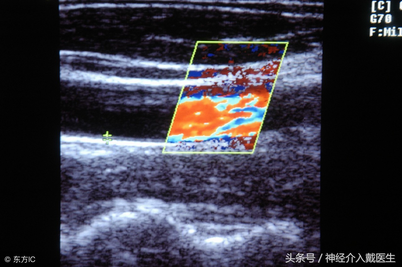 检查脑动脉硬化用什么仪器,脑血管检测仪器