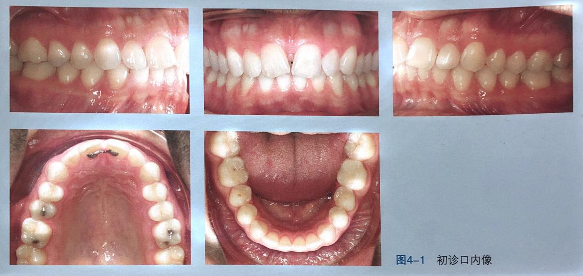 牙齿上的黑三角怎么回事,牙齿上的黑三角怎么改善