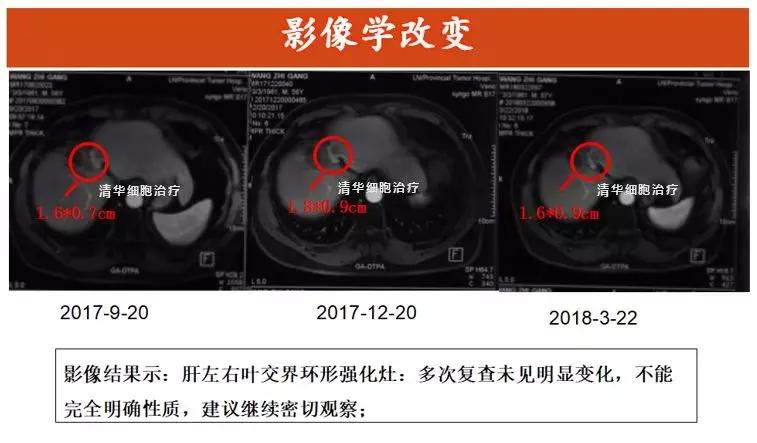 「肝胆管细胞癌，NKT治疗案例展示」清华NKT·乐和亲友·2016-43