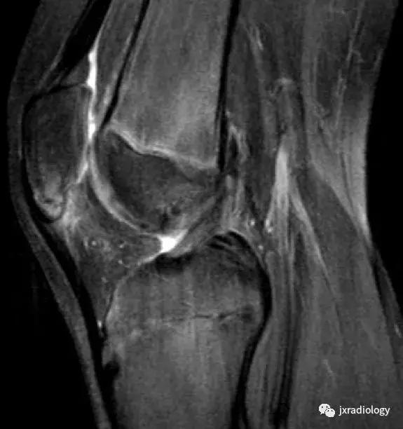 膝关节骨髓水肿疼痛特点,膝关节骨髓水肿的临床表现