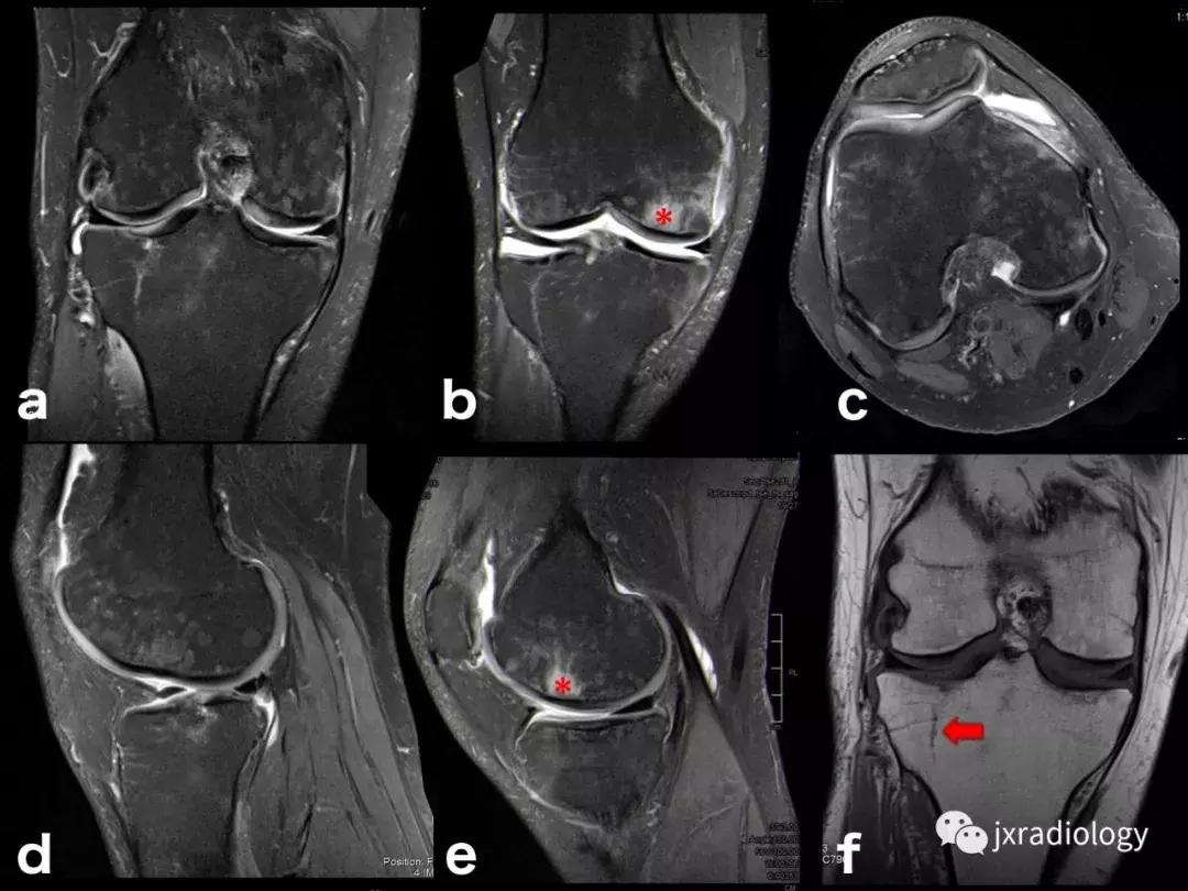 膝关节骨髓水肿疼痛特点,膝关节骨髓水肿的临床表现