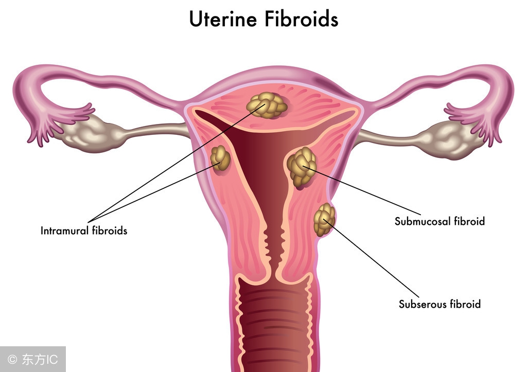 子宫肌瘤继发感染和变性哪个严重,子宫肌瘤继发变性有哪几种