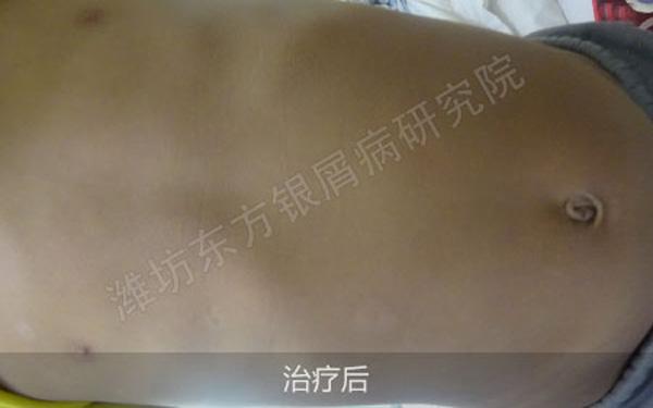 银屑病儿童好了有没有不复发的,治疗儿童银屑病全国哪家医院好