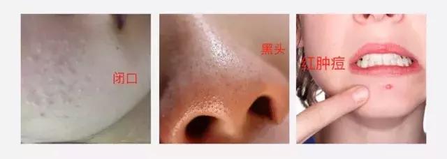 用范冰冰和林允都安利的祛痘神器，痘痘闭口