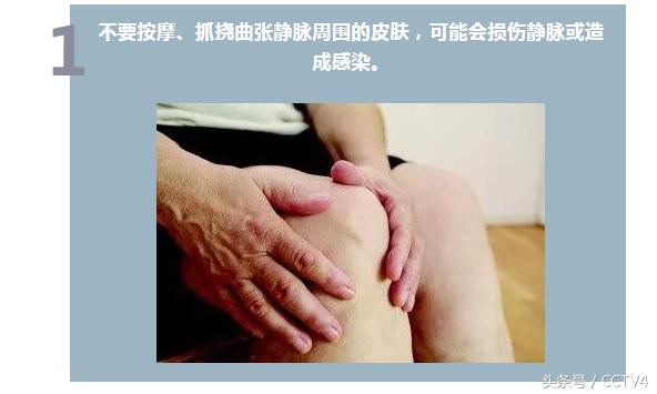 蚯蚓纹是怎么回事呢,大腿根部蚯蚓纹越来越多