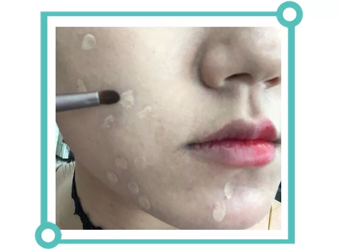 怎样消除痘印食疗,青春期痘印怎么消除小妙招