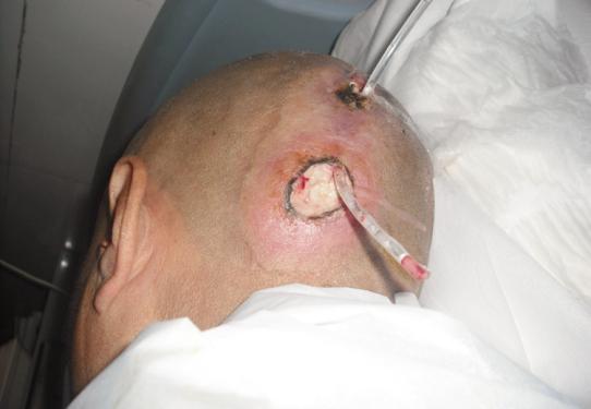 血糖高怎么办糖尿病早期10个征兆,糖尿病并发症病人临死有什么征兆