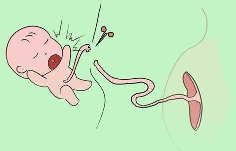 肚脐眼里抠出来粘稠的白色物质,肚脐眼里的泥用镊子取出