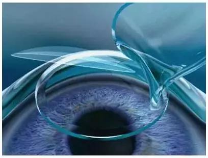 全飞秒和半飞秒治近视可重复做吗,全飞秒与半飞秒的治疗效果