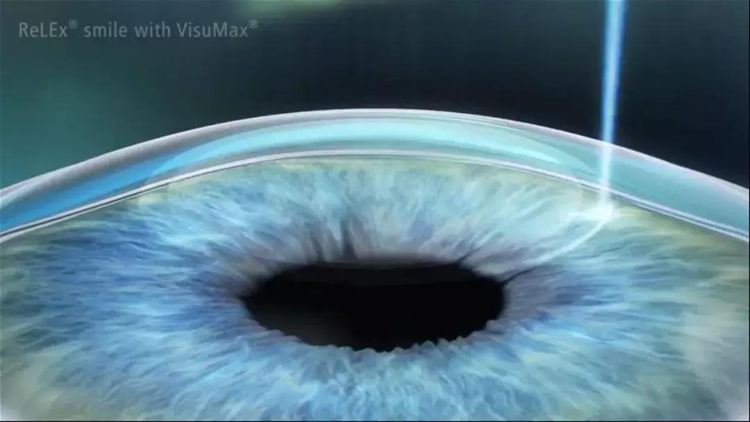 全飞秒和半飞秒治近视可重复做吗,全飞秒与半飞秒的治疗效果