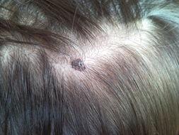 嘴上一个黑痣,嘴上有一颗很大的痣去掉后的图