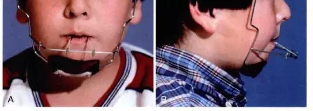 牙齿正畸堪比整容,牙齿矫正堪比整形