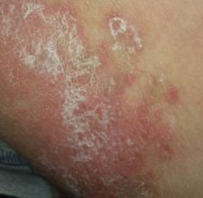 洁尔阴洗剂,洁尔阴洗剂用一天管用吗