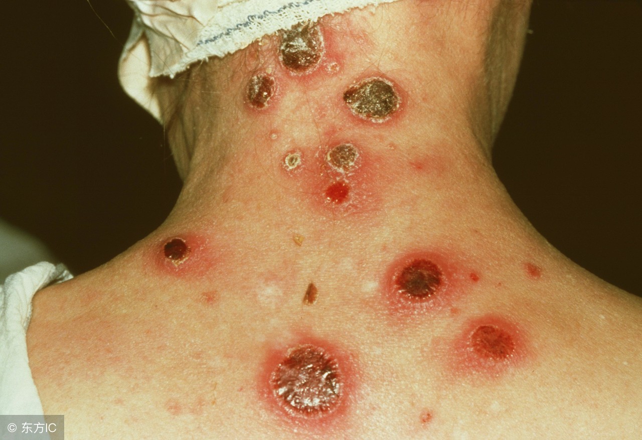 胎传梅毒能治好吗,胎传梅毒能治愈吗