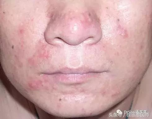 专业去除各种斑痘,专治脸上各种斑各种痘