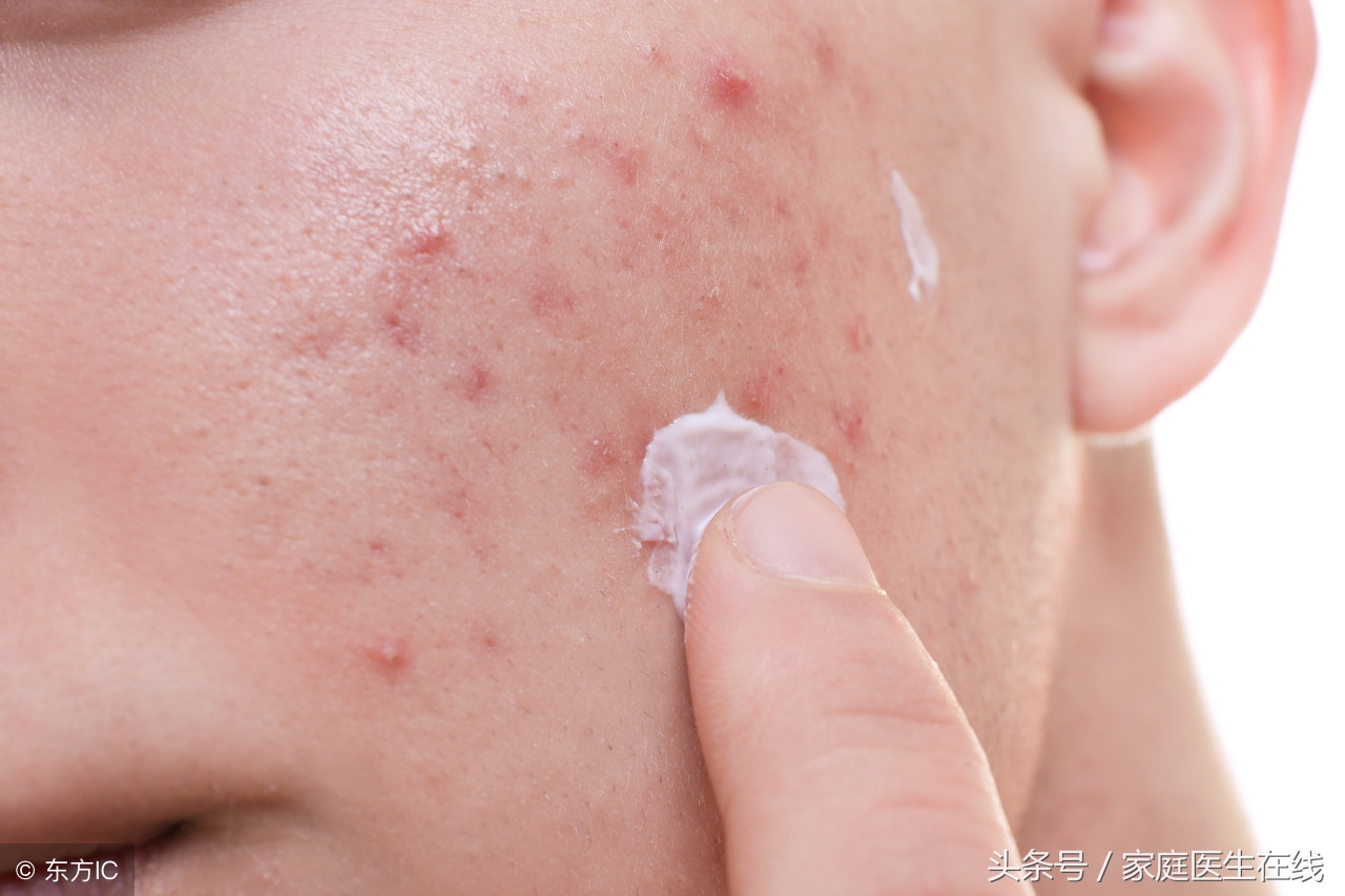 如何正确去除痘痘和痘印,痘印有什么办法可以去除