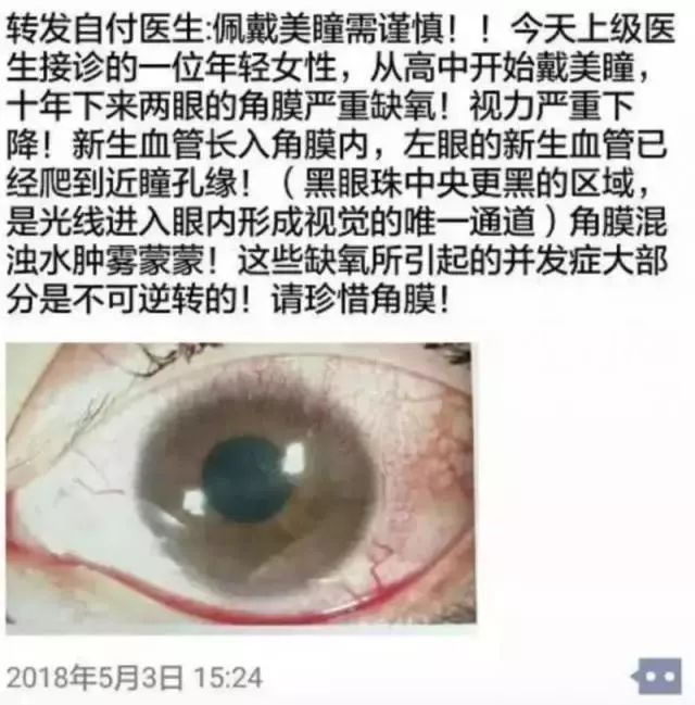 警惕来路不明的美瞳暗藏风险,99%都不知道的美瞳的危害