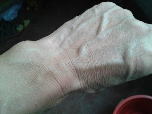 手上青筋怎么治愈呢,可以看到手上的青筋是怎么回事