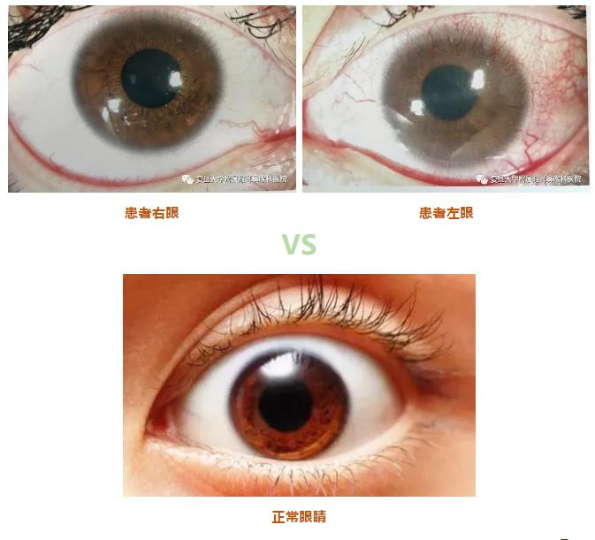 美瞳新手入门佩戴,美瞳新手推荐及注意事项